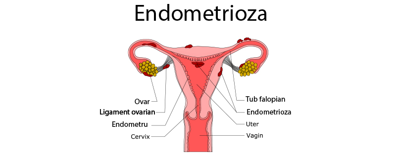 cum pot să pierd greutatea cu endometrioza