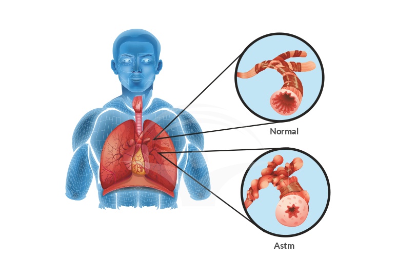 Astm bronsic - Obstructia respiratiei normale