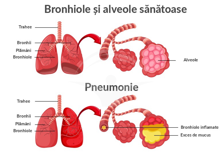 pneumonie și prostatita