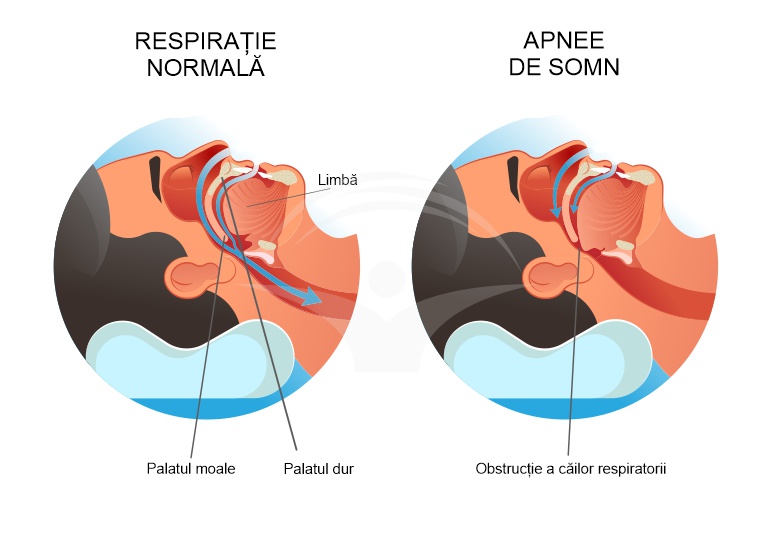 Exerciții de respirație după operația de adenom de prostată