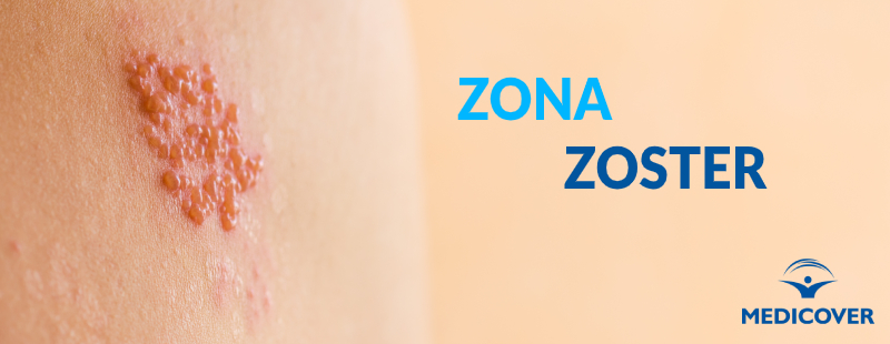 Zona Zoster – simptome, manifestari, tratament
