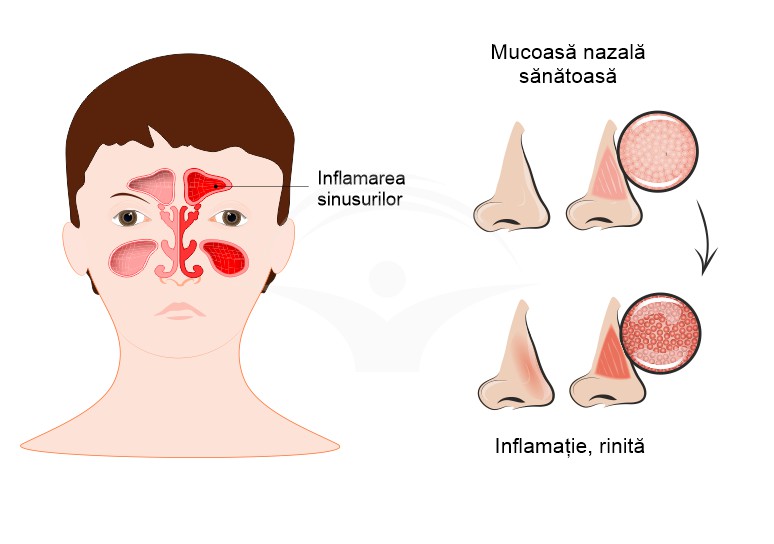 Rinita non-alergica: cauze, simptome si diagnostic