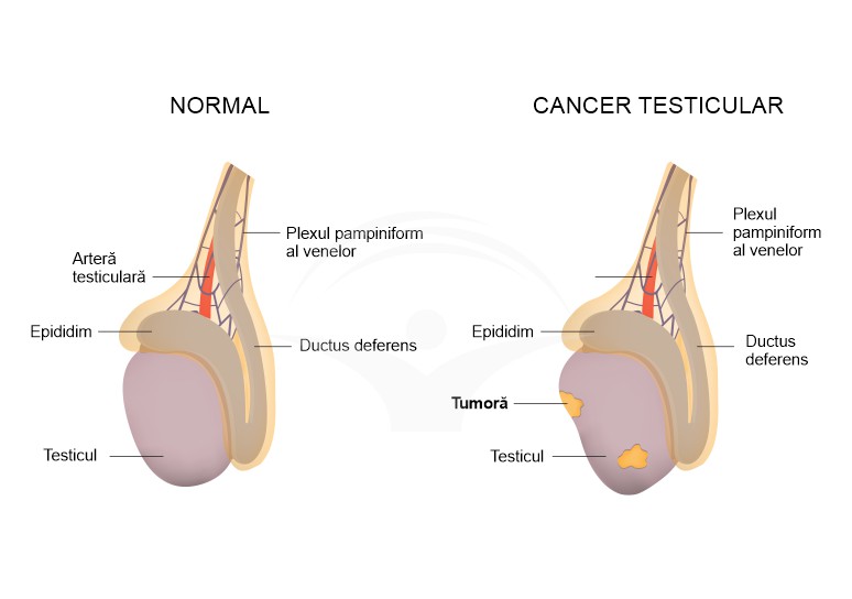Cancer testicular: cauze, simptome si tratament