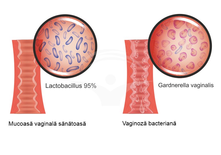 Vaginoza bacteriana: cauze, simptome si tratament