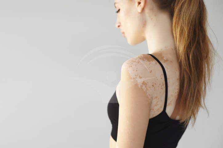 Depigmentarea pielii