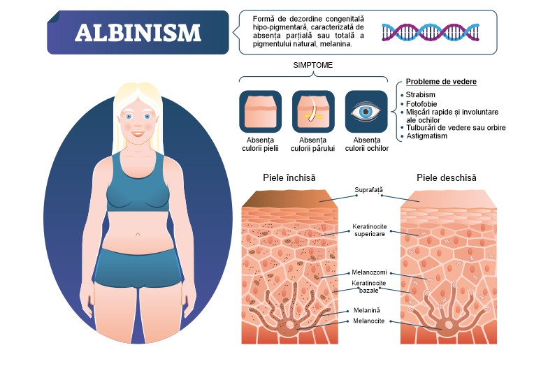 Albinismul: cauze, simptome si diagnostic