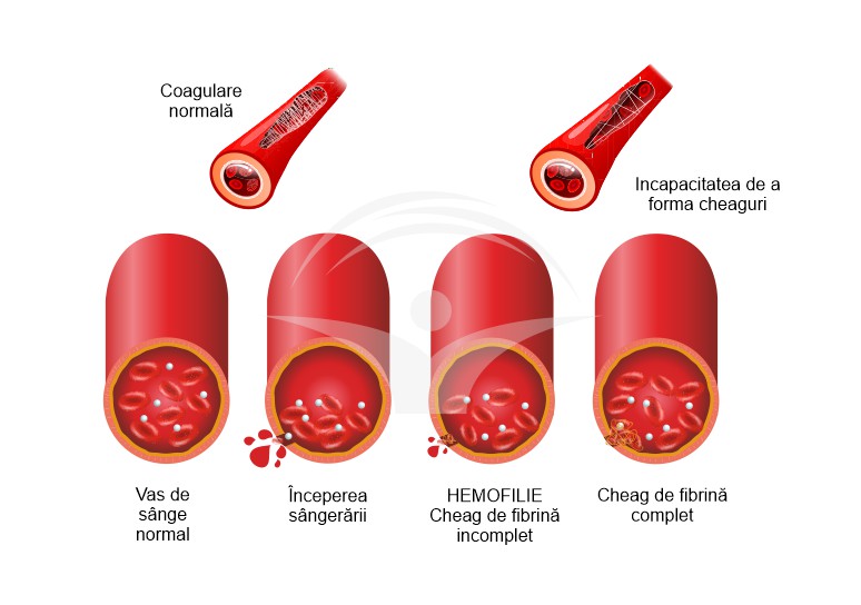 Hemofilia: cauze, simptome si tratament