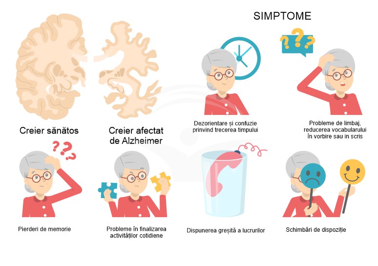 Boala Alzheimer: cauze, simptome si tratament