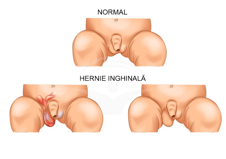 Forum de hernie inghinală și adenom de prostată