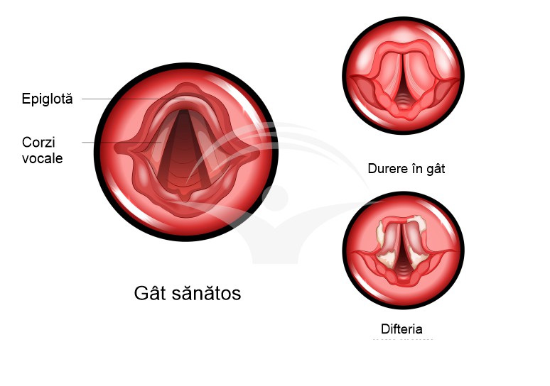 Difteria: cauze, simptome si tratament