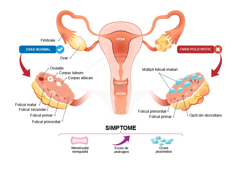 Sindromul ovarelor polichistice: cauze, simptome si tratament