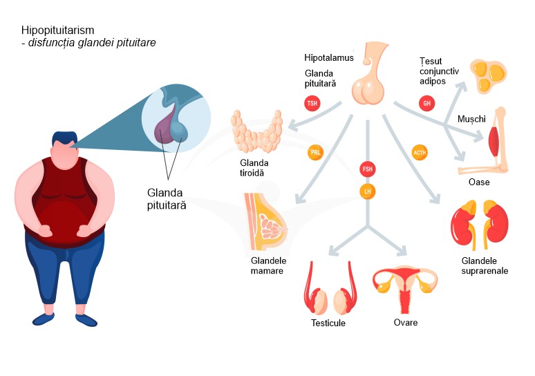 Hipopituitarism: cauze, manifestari clinice si investigatii