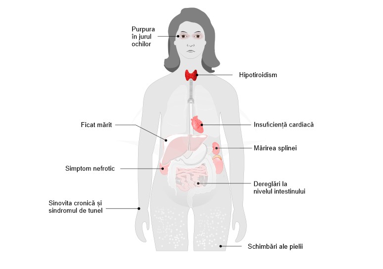 Amiloidoza: cauze, simptome si tratament