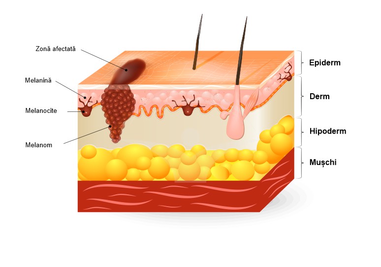 Melanom: forme clinice, manifestari si tratament