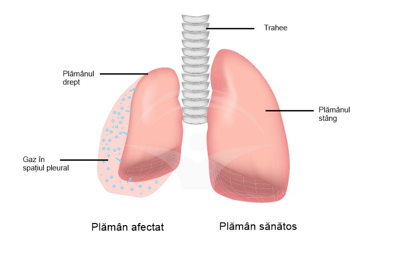 Pneumotorax: cauze, simptome si tratament