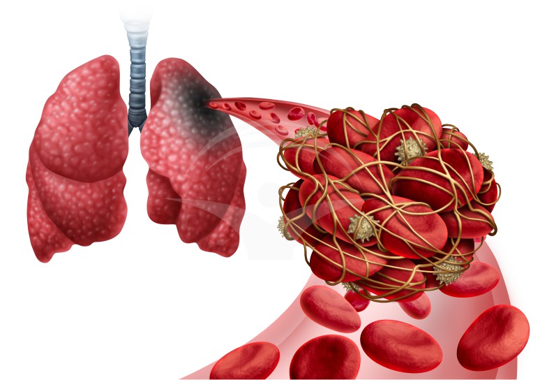 Trombembolism pulmonar: cauze, simptome si tratament