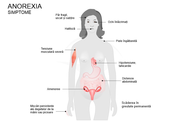 Anorexia nervoasa: cauze, simptome si tratament 