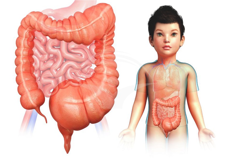 Megacolon toxic: cauze, simptome si tratament
