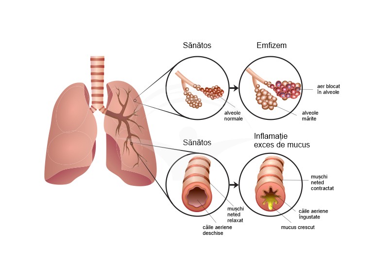 Boala pulmonara cronica obstructiva (BPOC): cauze, simptome si tratament
