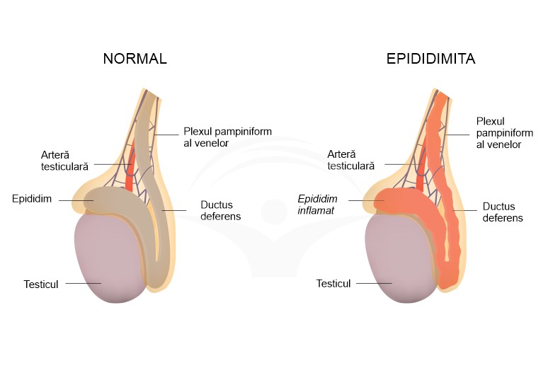 Epididimita: cauze, simptome si tratament