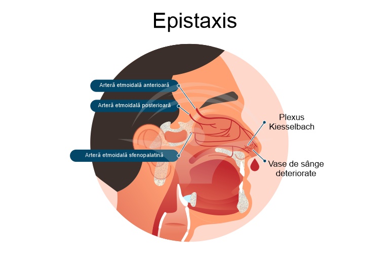 Epistaxis