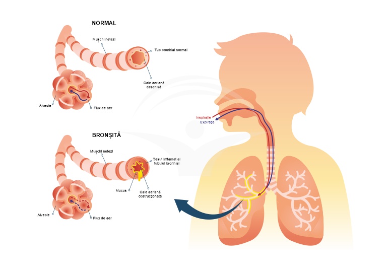 Diferența dintre cancerul pulmonar și bronșită Diferența dintre - 2021 - Altele