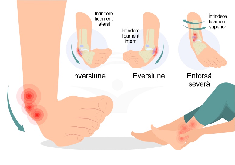 Entorsa - cum apare si cum o tratam