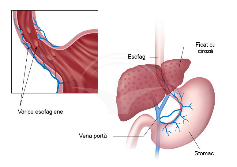 Ciroza hepatica si varice esofagiene