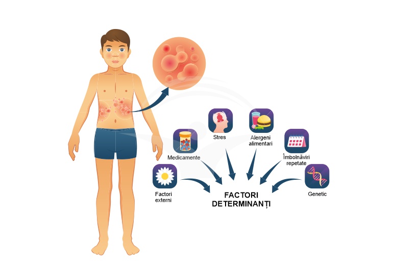 Urticaria - de ce apare si cum o&nbsp;tratam