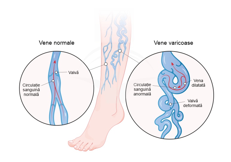 Pregatiri în tratamentul extremitailor de jos în varicoza, Picioare violete și varice