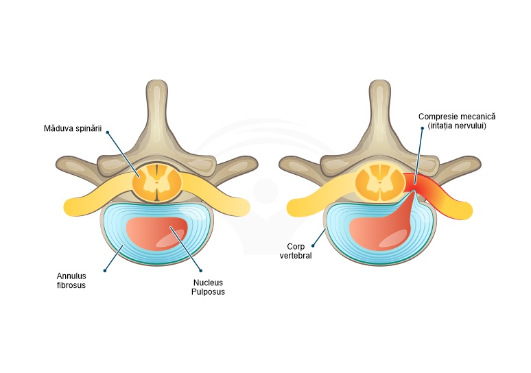prostatita și hernia coloanei vertebrale