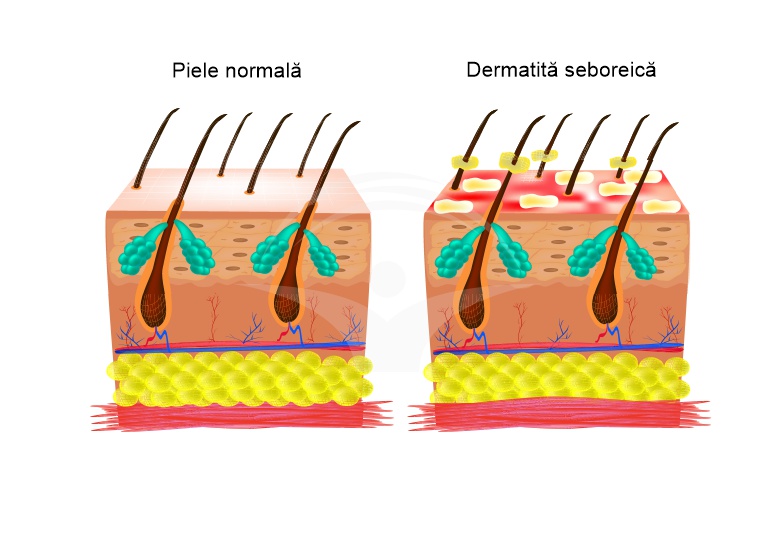 Dermatita seboreica - factori favorizanti si tratament