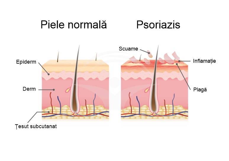 Psoriazis: cauze, forme de boala, diagnostic