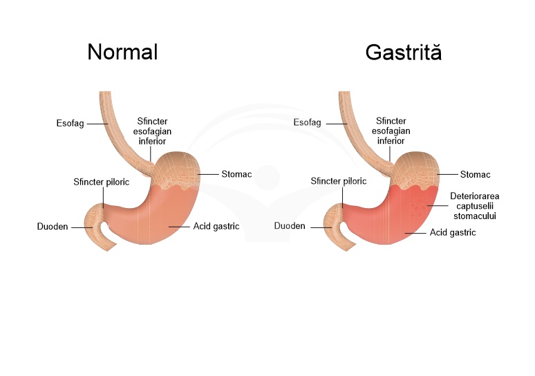 tratamentul prostatitei cu gastrită)