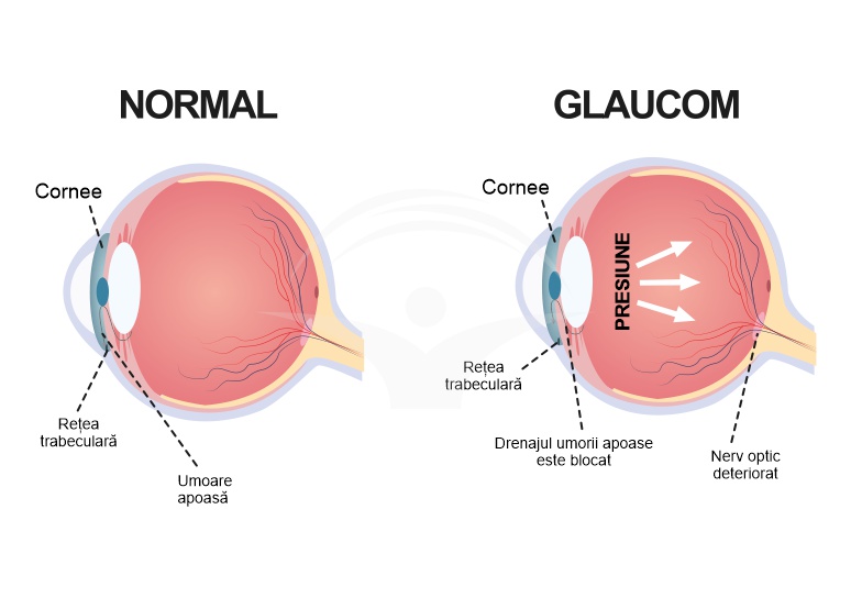 Glaucomul - clasificare, cauze, manifestari si tratament