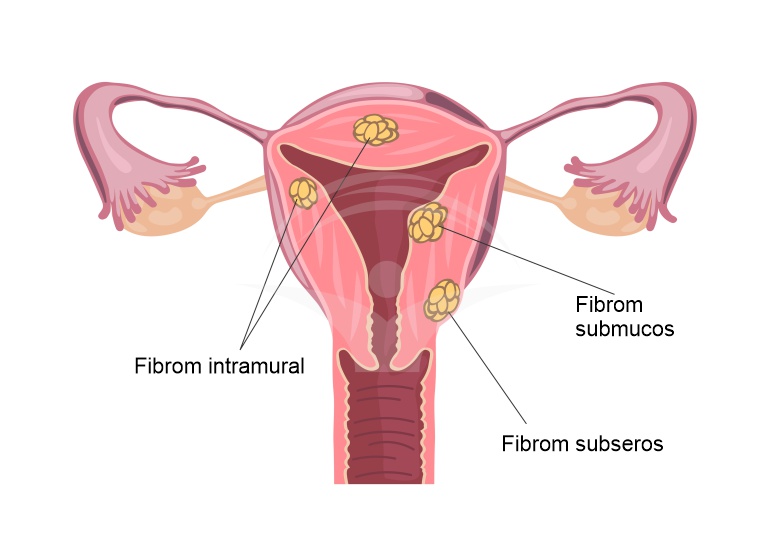 Fibromul uterin - factori determinanti, simptome si tratament