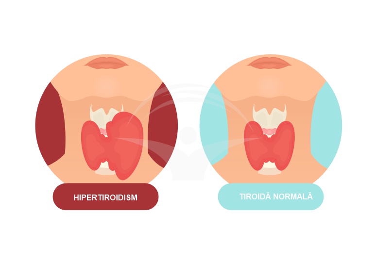Hipertiroidismul - de ce apare, cum se manifesta, tratament