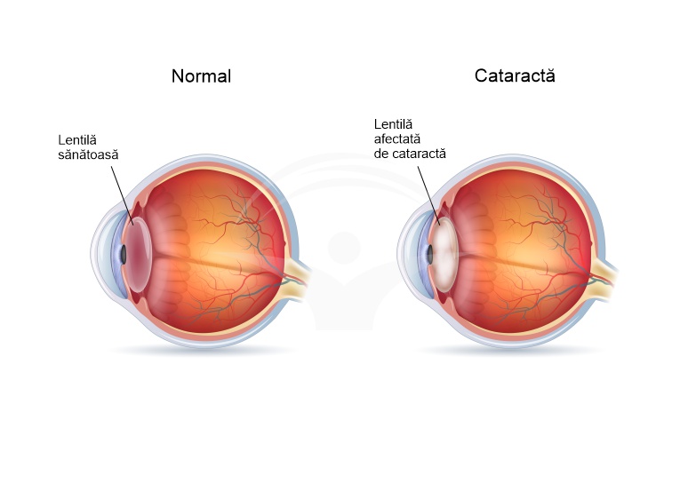 Cataracta - cauze, forme, manifestari clinice tratament