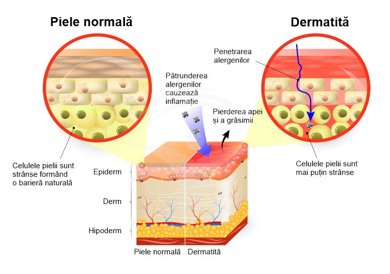 Dermatita: cauze, simptome, tratament