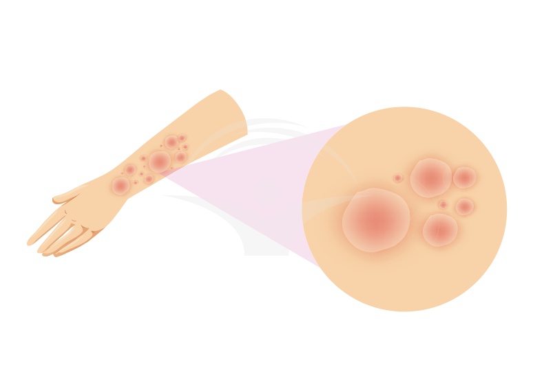 Lichenul plan: cauze, forme clinice si tratament