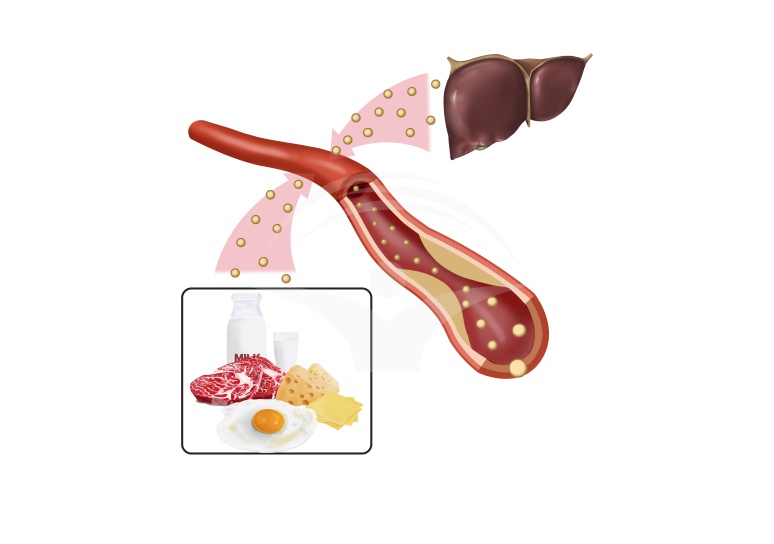 Hipercolesterolemia la copii si adolescenti