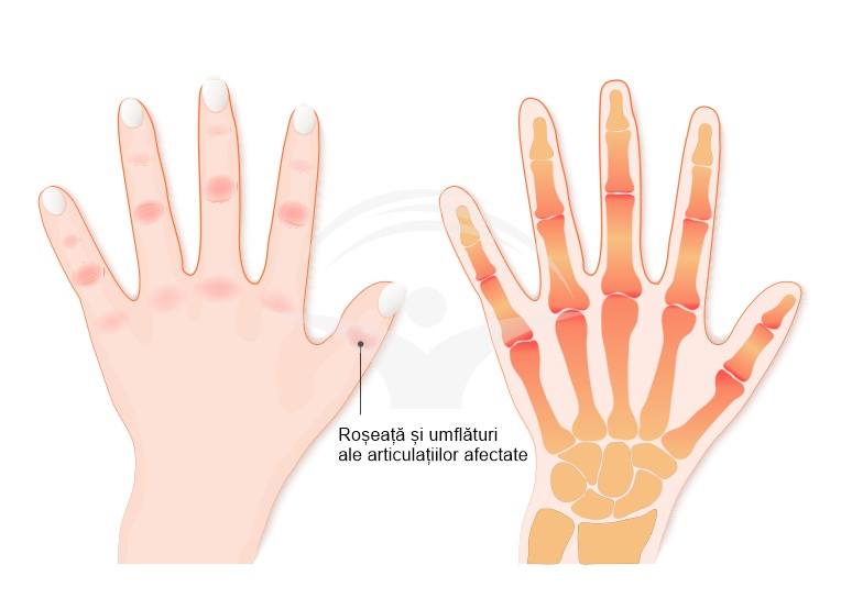 artrita acuta simptome