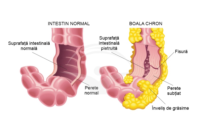 Boala Crohn: cauze, simptome, tratament