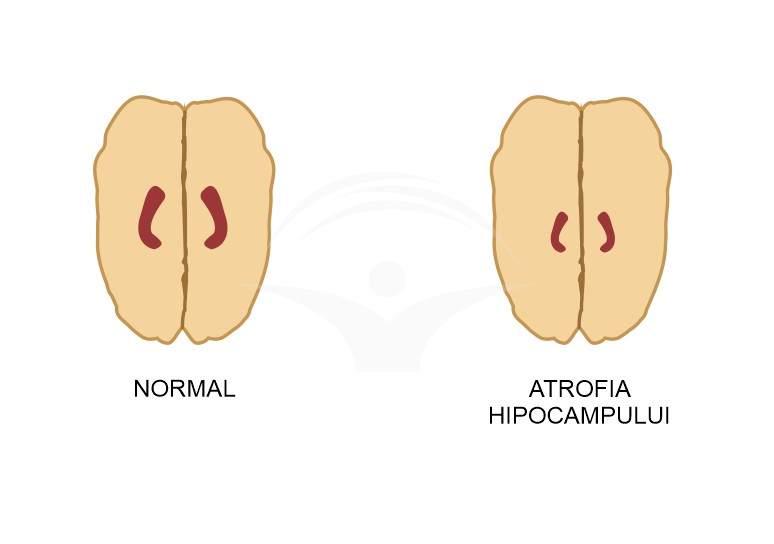 Atrofia cerebrala: cauze, simptome, tratament