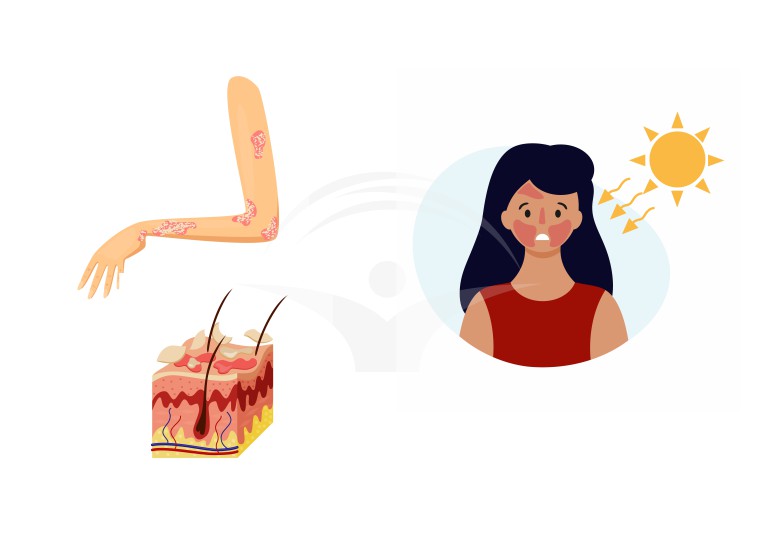 Alergia solara: forme clinice, simptome si tratament