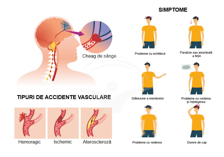 Informatii utile despre accidentul vascular cerebral