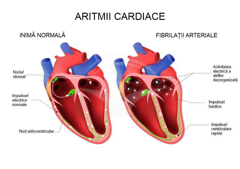prostatita si aritmia cardiaca