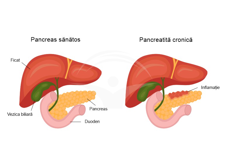 Pancreatita cronica: cauze, simptome si tratament