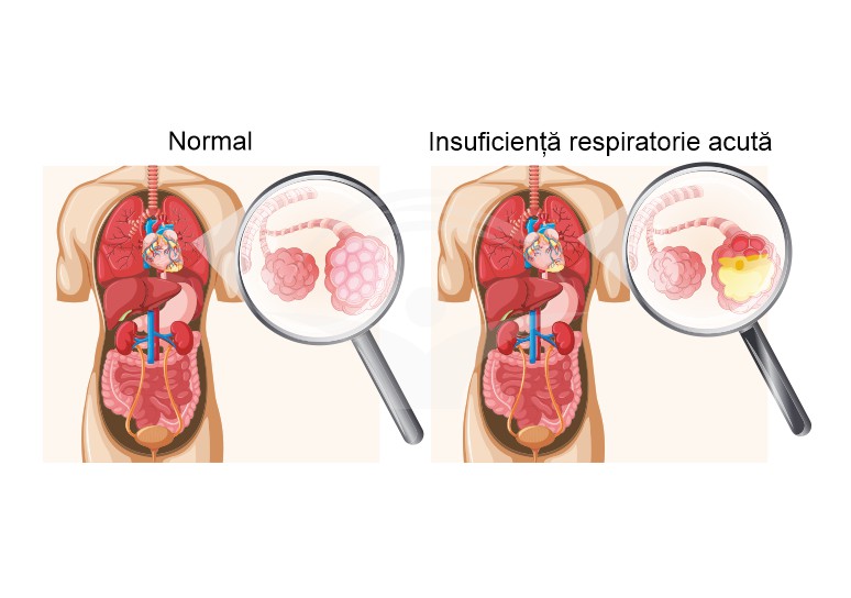Insuficienta respiratorie acuta: diagnostic