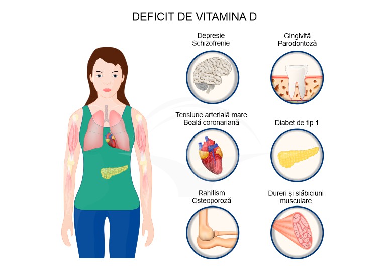 Carenta sau deficitul de vitamina D